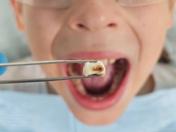 Best Emergency Treatment for Dental Infections or Abscesses in Richland Hills, TX
